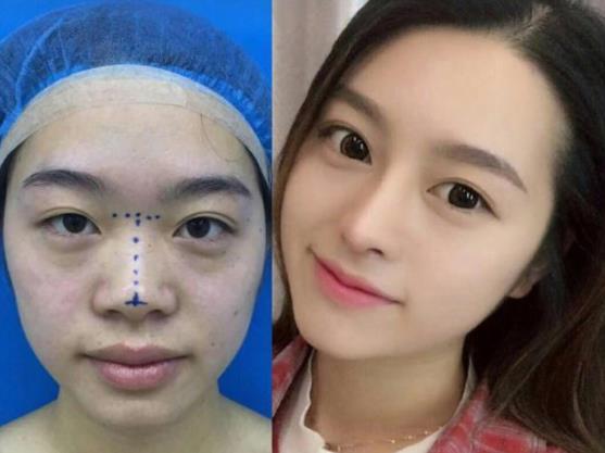 玻尿酸隆鼻手術效果如何(優勢、副作用等)