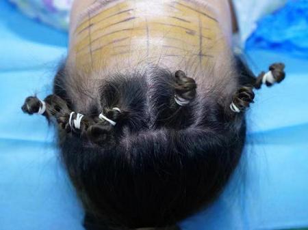 王海木專家解答:為什么在面部提升中需要應用內窺鏡? 王海木專家解答:為什么在面部提升中需要應用內窺鏡?