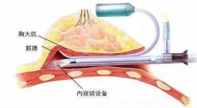 王海木專家解答:為什么在面部提升中需要應用內窺鏡? 王海木專家解答:為什么在面部提升中需要應用內窺鏡?