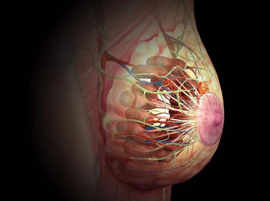 乳腺癌是怎么引起的?乳腺癌早期癥狀