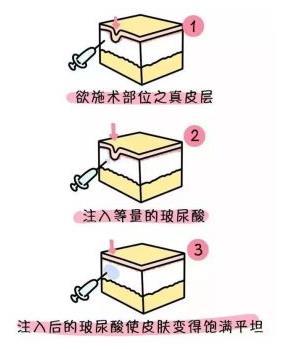 看不到耳朵該選貼發耳矯正手術還是玻尿酸?余文林博士告訴你! 看不到耳朵該選貼發耳矯正手術還是玻尿酸?余文林博士告訴你!