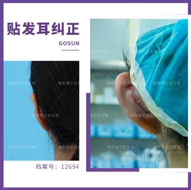 看不到耳朵該選貼發耳矯正手術還是玻尿酸?余文林博士告訴你! 看不到耳朵該選貼發耳矯正手術還是玻尿酸?余文林博士告訴你!