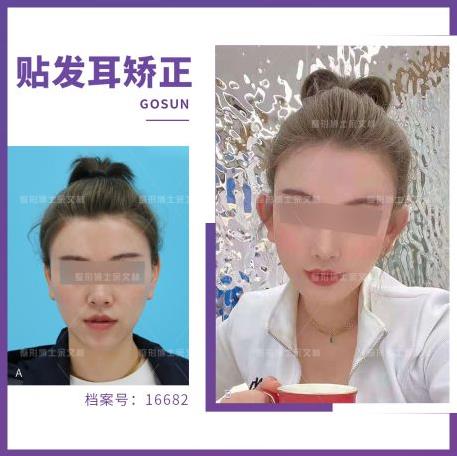 看不到耳朵該選貼發耳矯正手術還是玻尿酸?余文林博士告訴你! 看不到耳朵該選貼發耳矯正手術還是玻尿酸?余文林博士告訴你!