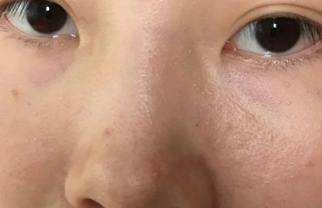 臉上總出油是怎么回事?臉愛出油的常見兩個因素 臉上總出油是怎么回事?臉愛出油的常見兩個因素