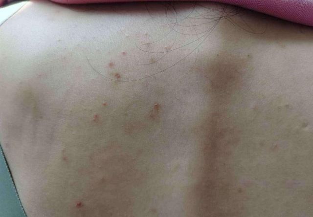 后背長痘痘注意避免這些情況 汗水導(dǎo)致細(xì)菌生長 后背長痘痘注意避免這些情況 汗水導(dǎo)致細(xì)菌生長