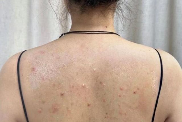 背部有痘痘的原因 對癥解決效果好 背部有痘痘的原因 對癥解決效果好