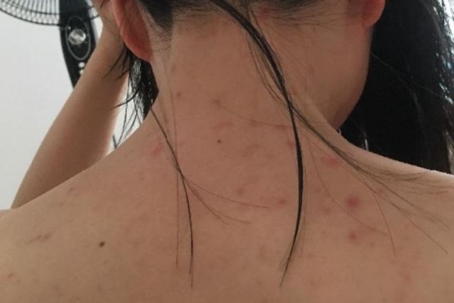 爽身粉對后背痘痘有效嗎 背上長痘痘的原因和解決方法 爽身粉對后背痘痘有效嗎 背上長痘痘的原因和解決方法