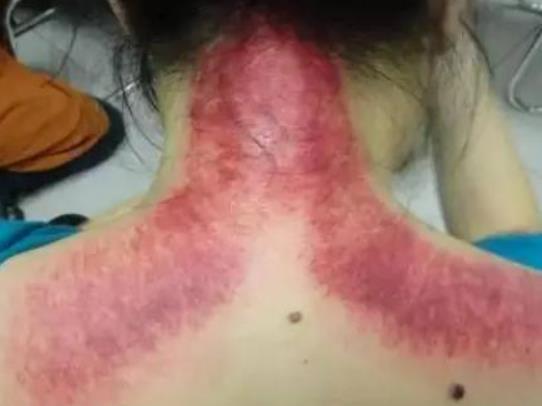 孩子咳嗽能刮痧嗎?刮痧后多久才能洗澡 孩子咳嗽能刮痧嗎?刮痧后多久才能洗澡