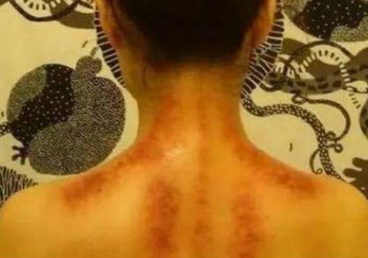 一刮就出痧是濕氣重嗎?女性刮痧有什么壞處 一刮就出痧是濕氣重嗎?女性刮痧有什么壞處